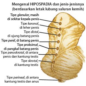 Tipe Hipospadia Tipe Hipospadia